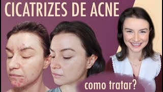 Como eu tratei as minhas cicatrizes de acne  Opinião de Esteticista cicatrizesdeacne [upl. by Airdnat]