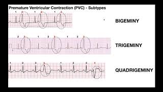 EKG Patterns  Premature Atrial amp Ventricular Contractions PACs amp PVCs [upl. by Ailahs]