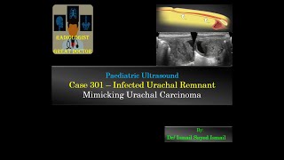 Ultrasound Case 301  Infected Urachal Remnant [upl. by Kinnard]