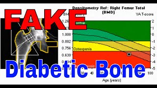 Discovering The Shocking Paradox Of Diabetic Bone Marrow [upl. by Apilef]