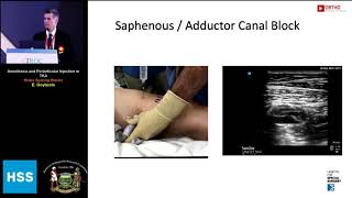 Anesthesia and Periarticular Injection in TKA Motor Sparing Blocks  Dr E Goytizolo [upl. by Hobie]