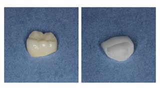 The Benefits of Zirconia Crowns [upl. by Jesus225]