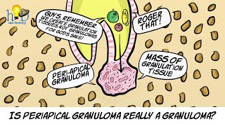 What is periapical granuloma [upl. by Neerahs]