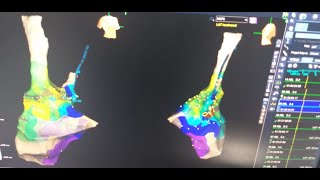 FascicularVT ablation procedure IN 90 SEC [upl. by Varien349]