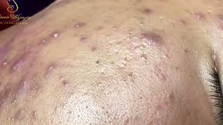 Loan Nguyen Acne Treatment 1623h [upl. by Emearg960]