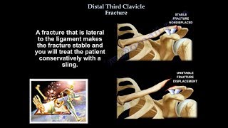 Distal Third Clavicle Fracture  Everything You Need To Know  Dr Nabil Ebraheim [upl. by Ellinad]