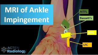 MRI of anterolateral ankle impingement [upl. by Eneirda]