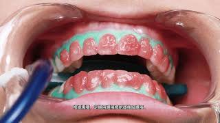 Chinese Subtitles  Opalescence™ Boost™ Professional Teeth Whitening  StepbyStep Procedure [upl. by Alger]