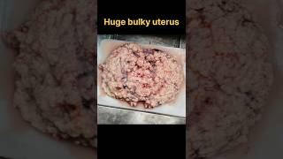 Huge fibroid uterus with secondary changes specimen for histopathology  histopathology [upl. by Ritchie]