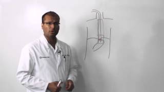 Esophagectomy Treatment of Esophageal Cancer [upl. by Roane]