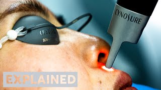 EXPLAINED PicoSure Pro Laser  London [upl. by Lothario]