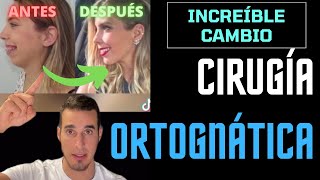 CAMBIÓ su CARA por completo  CIRUGÍA ORTOGNÁTICA [upl. by Barth124]