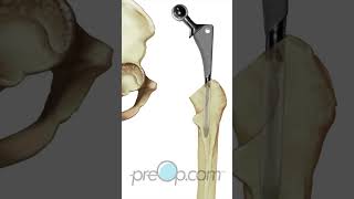 Total Hip Replacement Patient Education shorts [upl. by Roland]