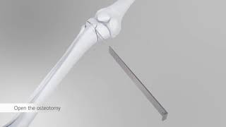 AO HTO Tomofix anatomical DePuy Synthes [upl. by Laurin267]