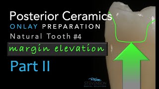 Zirconia Ceramics Part 2 Posterior Ceramic Onlay Preparation  Margin Elevation [upl. by Ricky]