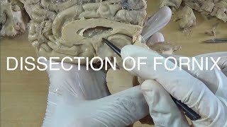 DISSECTION OF FORNIX [upl. by Ellingston]