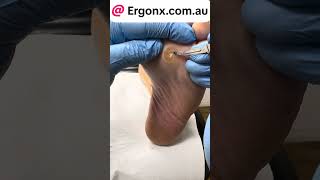 Painful hard corn removed from the forefoot of a carpenter [upl. by Beasley418]