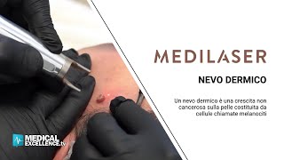 Vaporizzazione di un nevo dermico con laser CO2 efficace e indolore [upl. by Haimerej]