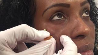 Dark Circles Under Eyes Filler Treatment Best Remedy [upl. by Flodnar]