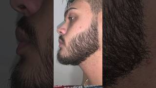 EVOLUÇÃO COM MINOXIDIL  7 MESES de tratamento antes e depois minoxidil barba barbearia [upl. by Eydie]