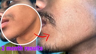 Minoxidil beard growth  2 month beard journey  transformation [upl. by Ivette654]