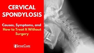 CERVICAL SPONDYLOSIS Causes Symptoms and Treatment NO SURGERY [upl. by Peddada]