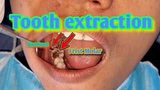 Tooth extraction  1 Molar and just root  TEETH SMILE RESTORATION [upl. by Yetti31]