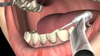 What are Dental Veneers [upl. by Nagaek]