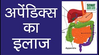 अपेंडिक्स का इलाज  Treatment Of Appendicitis  Appendicitis Treatment [upl. by Indnahc]