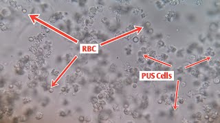 See The Clear PUS Cells amp RBC Microscopic Examination of Urine [upl. by Nerad571]