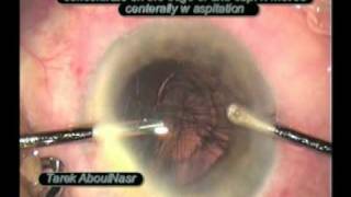 zonular dialysis  dehiscnece during phaco [upl. by Marfe318]