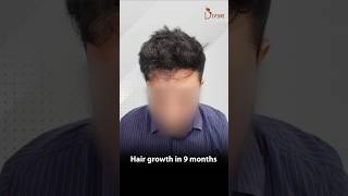 Hair Restoration at Divine Hair Transplant Before and After shortfeed2024 [upl. by Assirol540]