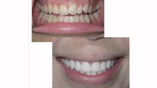 How Invisalign Works [upl. by Rosalia]