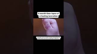 I needed STITCHES 6 month WOUND HEALING timelapse [upl. by Soutor826]