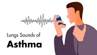 Sounds of Asthma  Wheezing Lung Sounds [upl. by Nealy]