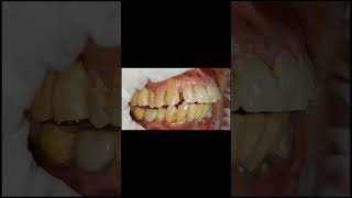 Flat occlusal contour for implant molar crown for generalised attrited dentition shorts [upl. by Llenoil]