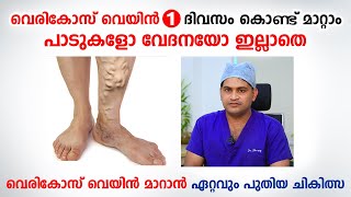 വെരികോസ് വെയിൻ ഒരു ദിവസം കൊണ്ട് മാറ്റാം  Varicose veins malayalam  Dr Muhammed Shareef [upl. by Enawyd]