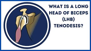 What is a Long Head of Biceps LHB Tenodesis [upl. by Atival]