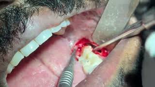 Surgical removal of impacted mandibular molar [upl. by Lotsirb]