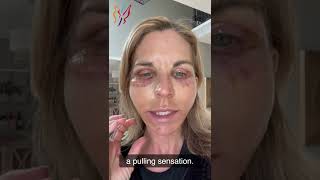 My Advanced Facelift Recovery Day by Day  Real Stories By Real Patients 2022 [upl. by Moir]