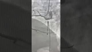 CSA RCA CTO antegrade approach with fielder xtspiral dissection in prox rca fb sealing with stent [upl. by Caras]