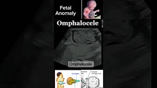 Prenatal Imaging of Omphalocele A Detailed Case Study casestudy anomally shorts DrSaimakhan [upl. by Azil]