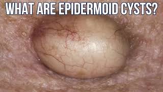 OOZY Epidermoid Cysts [upl. by Anirahc]