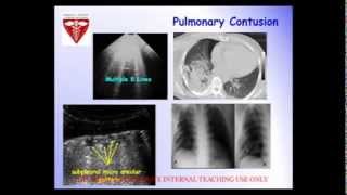 POC Webinar  EFAST ultrasound [upl. by Vania440]