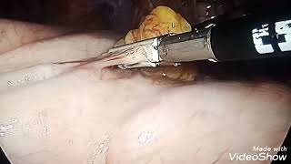 Laparoscopic Nissen fundoplication for Hiatal Hernia with GERD Za Abuja [upl. by Ileyan]