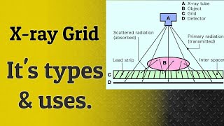 Xray Grid  Type of xray grids  Use of xray Grids  radiology lectures   enjeela shafat [upl. by Stormie]