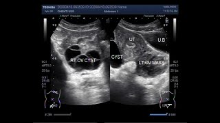 Ultrasound Video showing Two types of Ovarian Cysts and an Ovarian Mass [upl. by Saks922]