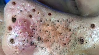 Big Cystic Acne Blackheads Extraction Blackheads amp Milia Whiteheads Removal Pimple Popping  148 [upl. by Arual296]