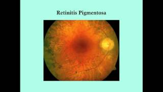 Retinitis Pigmentosa  CRASH Medical Review Series [upl. by Alina]