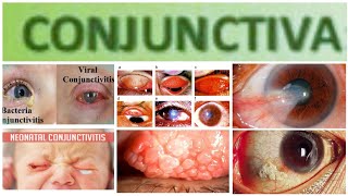 Conjuctiva 3 Major Topic Mucopurulent and Purulent Conjuctivitis [upl. by Jadda]